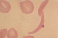 : : :  hemácias falciformes  : : :